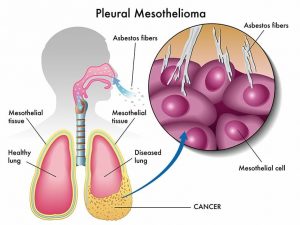 Statute of Limitations on Mesothelioma Claims